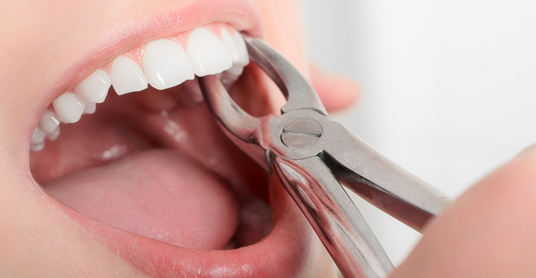 Tooth Extraction in Kitchener
