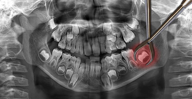 Wisdom teeth removal near me